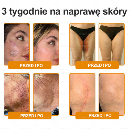 PUROSA®  Jad Pszczoły Kompleksowy Krem🥇pomaga w leczeniu problemów skórnych, takich jak: zmarszczki, blizny, plamy pigmentacyjne, rozstępy, trądzik, łuszczyca, egzema, zmiany skórne, podrażnienia, stany zapalne i inne problemy skórne🔥