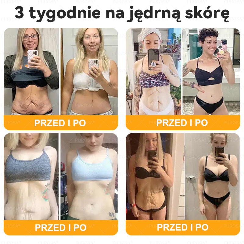 PUROSA®  Jad Pszczoły Kompleksowy Krem🥇pomaga w leczeniu problemów skórnych, takich jak: zmarszczki, blizny, plamy pigmentacyjne, rozstępy, trądzik, łuszczyca, egzema, zmiany skórne, podrażnienia, stany zapalne i inne problemy skórne🔥