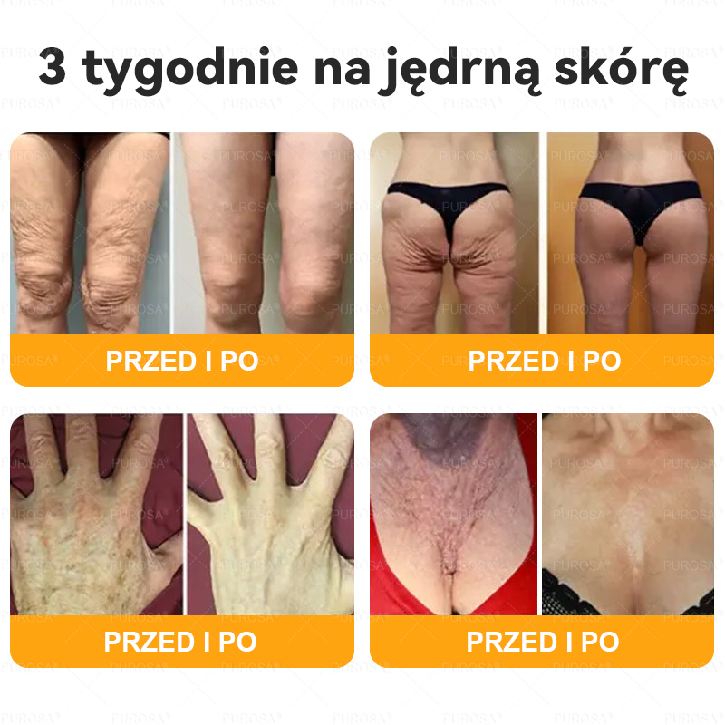 PUROSA®  Jad Pszczoły Kompleksowy Krem🥇pomaga w leczeniu problemów skórnych, takich jak: zmarszczki, blizny, plamy pigmentacyjne, rozstępy, trądzik, łuszczyca, egzema, zmiany skórne, podrażnienia, stany zapalne i inne problemy skórne🔥