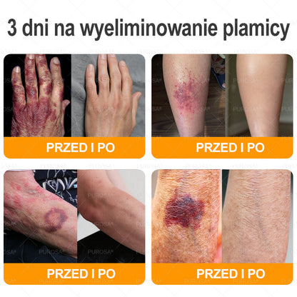 PUROSA®  Jad Pszczoły Kompleksowy Krem🥇pomaga w leczeniu problemów skórnych, takich jak: zmarszczki, blizny, plamy pigmentacyjne, rozstępy, trądzik, łuszczyca, egzema, zmiany skórne, podrażnienia, stany zapalne i inne problemy skórne🔥