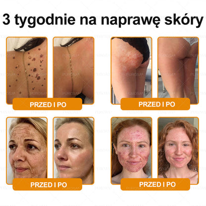 PUROSA®  Jad Pszczoły Kompleksowy Krem🥇pomaga w leczeniu problemów skórnych, takich jak: zmarszczki, blizny, plamy pigmentacyjne, rozstępy, trądzik, łuszczyca, egzema, zmiany skórne, podrażnienia, stany zapalne i inne problemy skórne🔥